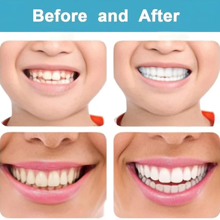 Instant Smile Snap-On Dental Veneers: Perfect Teeth Whitening & Correction Kit